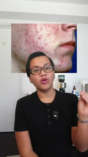 If pabalik balik acne mo, maybe there’s a missing piece sa skincare routine mo! 
