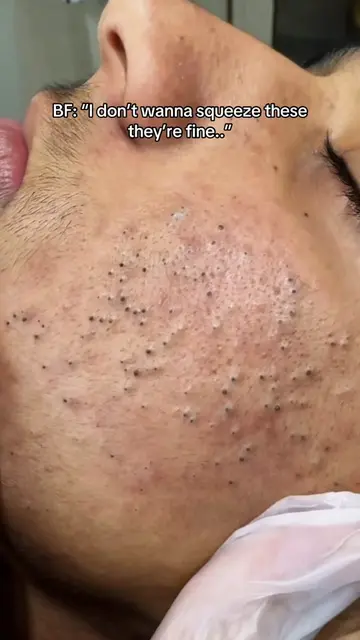 😳😳 #fyp #foryou #skincaretips 