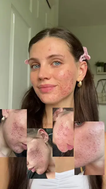 THANK YOU MICRONEEDLING ✨🤍 #acne #acnescars #microneedling #DIY #athomemicronee