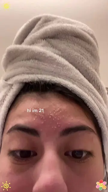😩Old acne scars and dull skin? Just 2 drops of niacinamide daily will amazingly