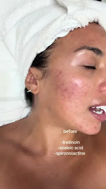 forever grateful for the big 3 (& SUNSCREEN) & my dermatologist ✨✨✨ #skincare #t