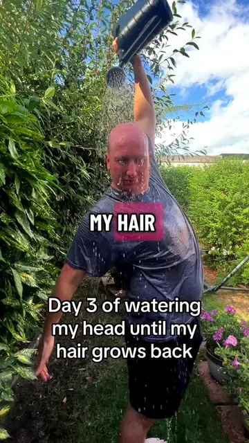 Day 3 of watering my head until my hair grows back 
