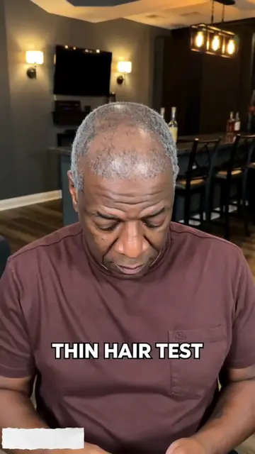 If you have thin hair and a visible hairline,and lack confidence every time you 