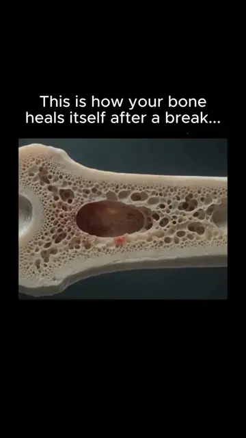 The moment a bone breaks, your body immediately forms a blood clot around the fr