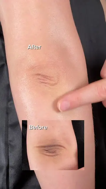 Dark elbows? 👀 Didn’t expect to see this much change in only 7 days.. @Arencia 