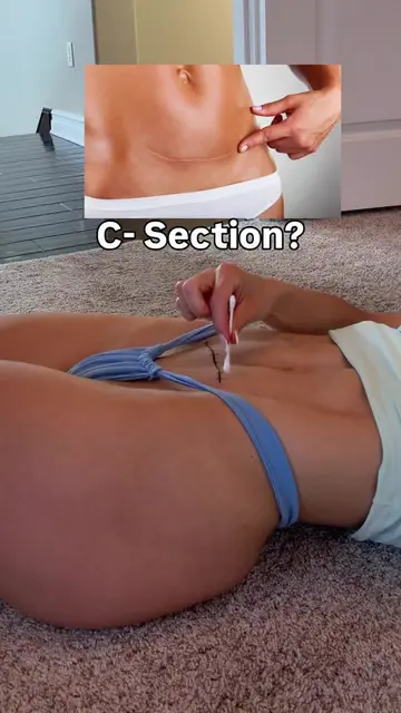 🚧 IS YOUR C-SECTION SCAR A ROADBLOCK? If you’re dealing with that stubborn C-se