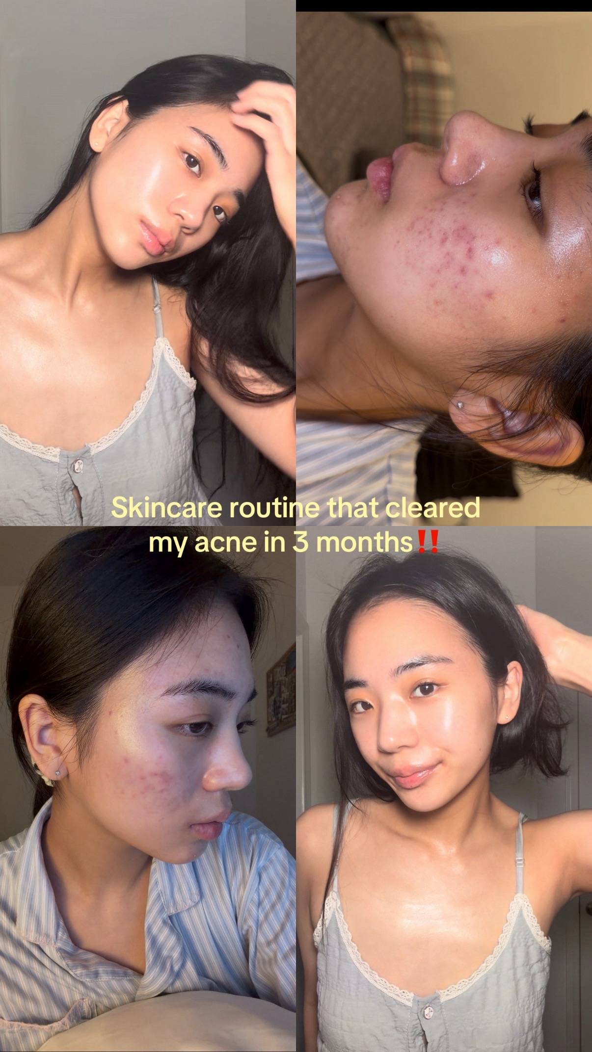 Skincare routine that cleared my acne in 3 months🥰 #skincare #acne #acnetreatme
