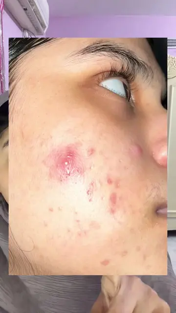 Detailed vdo 🥹 #foryourpage #support #goviral #skincaretips #skincareviral 