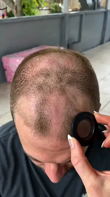 If you have thin hair and a visible hairline,and lack confidence every time you 