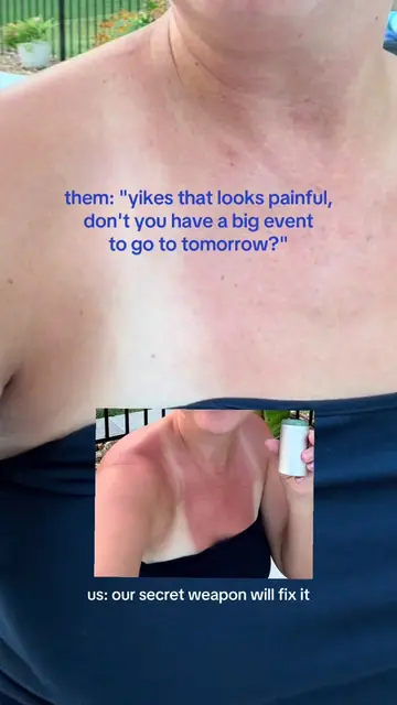 No worries over here #uv #sunburn #pool #fypシ #psa 
