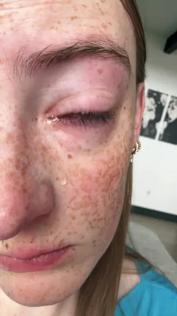 Do not cut corners when it comes to your contacts! I went blind from showering w