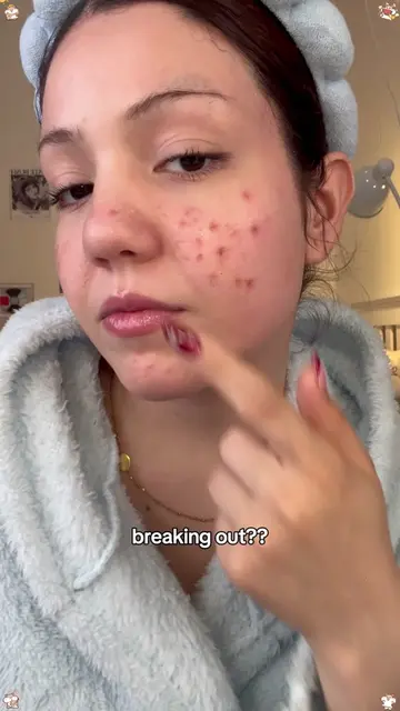 I stopped gambling with random “miracle acne fixes”. I just needed something ste