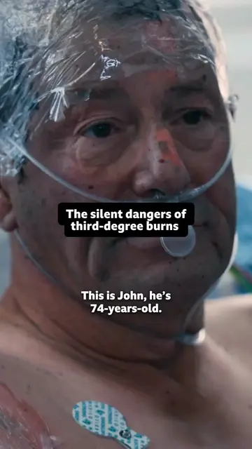 74-year-old John receives life-saving skin-graft surgery, after suffering severe