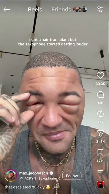 This hair transplant side effect is scary AF. Glad he is ok#hairtransplant #crea