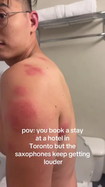 woke up at 5am to this… #bedbugs #hotel #toronto #viral #fyp