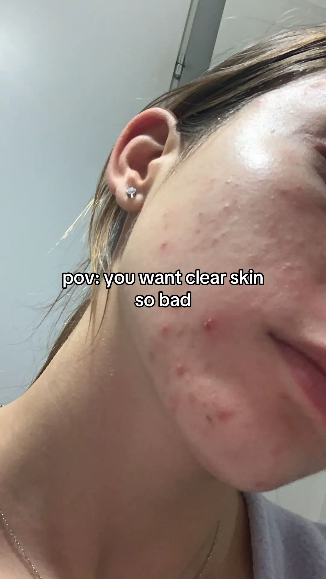 #acne #skincare #azelaicacid #345cream #clearskin 