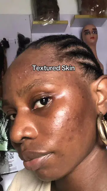 If you’re struggling with post-acne marks and hyperpigmentation, let me show you