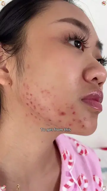 Promise me you'll get rid of acne completely before Christmas.#salicylicacid #ac