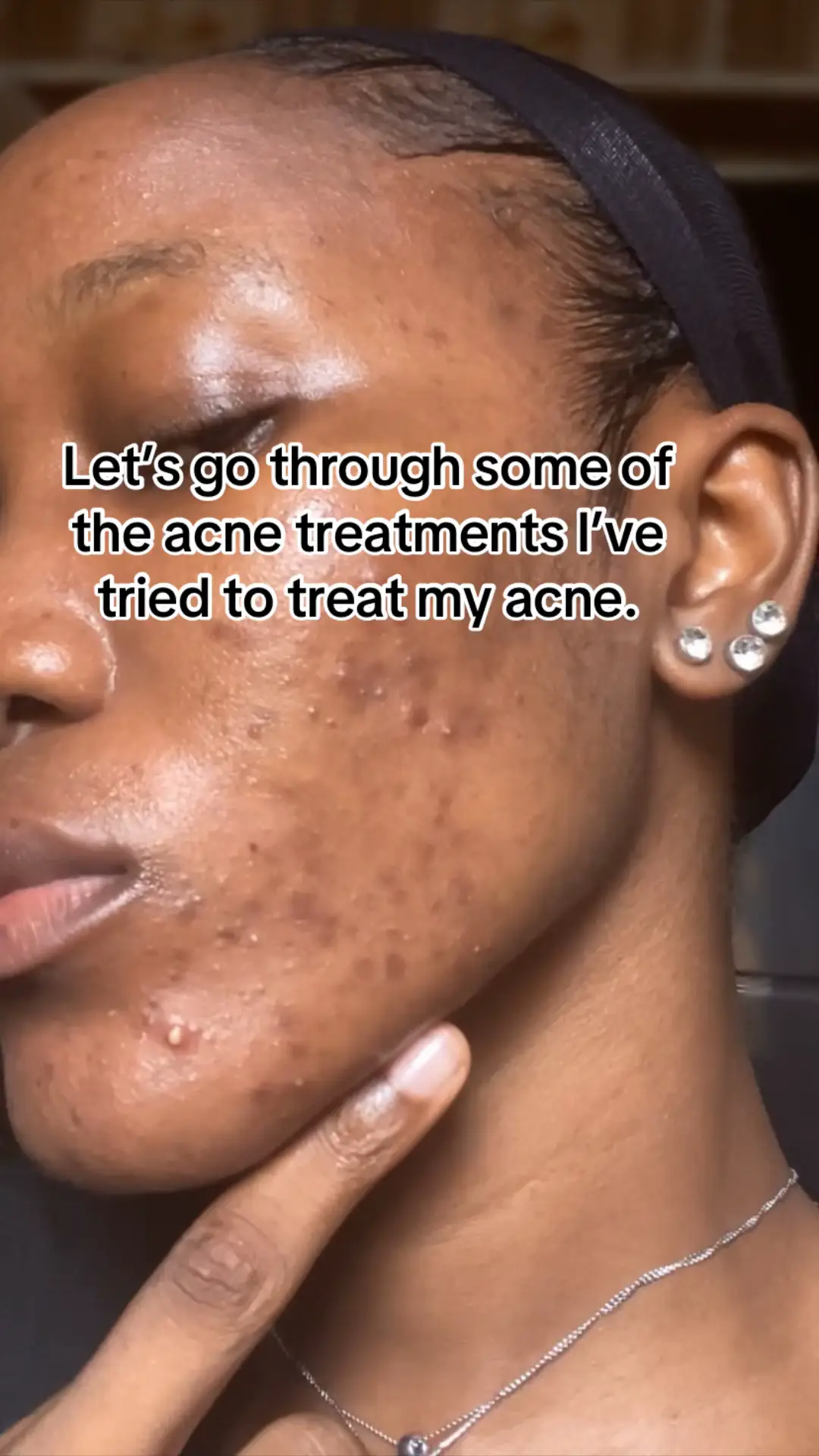 Acne treatments I’ve tried and my honest rating #avedoyah🌸  #acnetreatment  #ho