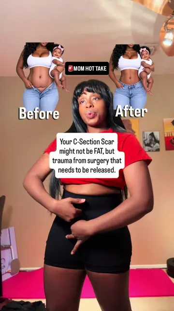 STOP calling your C-section shelf “fat” Sometimes what looks like stubborn fat a
