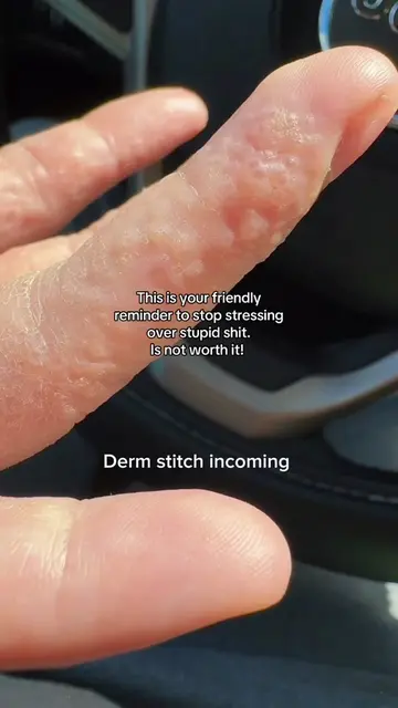 Hand eczema? Don't forget to try this one simple tip that can help! #dyshidrotic