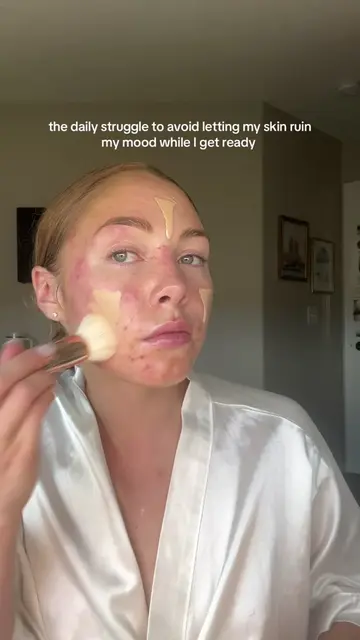 I’m sorry if you understand this. #acnestruggles #acne #gettingreadywithacne 