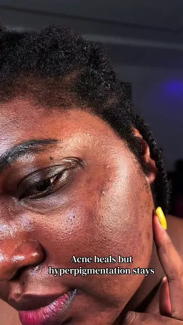 Acne may heal, but the marks it leaves behind can linger. That's why I'm loving 