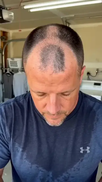 If you have thin hair and a visible hairline,and lack confidence every time you 