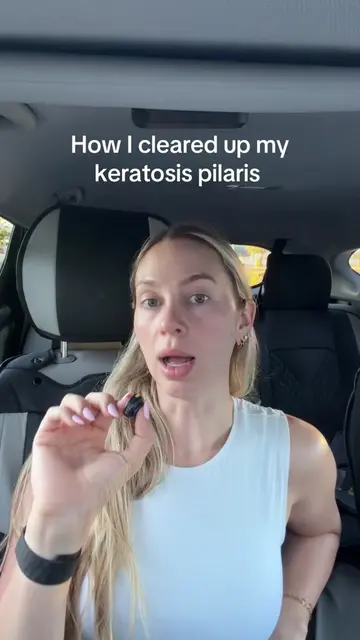 What actually worked for my keratosis pilaris and things you can do to improve y