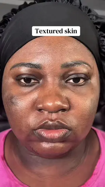 Acne to clear skin transformation with this duo @Dr.Althea US  #hyperpigmentatio