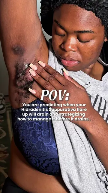 #HidradenitisSuppurativa 