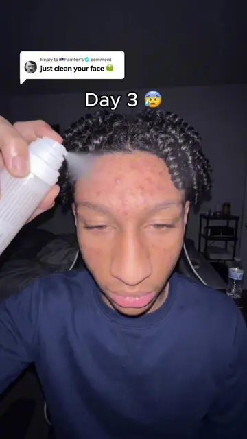 Am I chopped?🤷🏿‍♂️🥀 #acne #acnetreatment #acneproneskin #acnetips #acneskinca