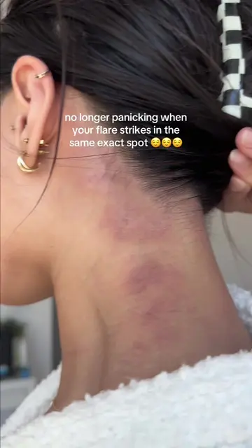 when your eczema has a favorite spot but you came prepared this time 🙂‍↕️💙 tag
