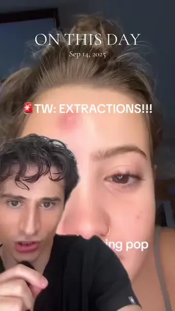 #onthisday MOST SATISFYING POP #dermreacts  #skincare  #dermatologist #dermangel