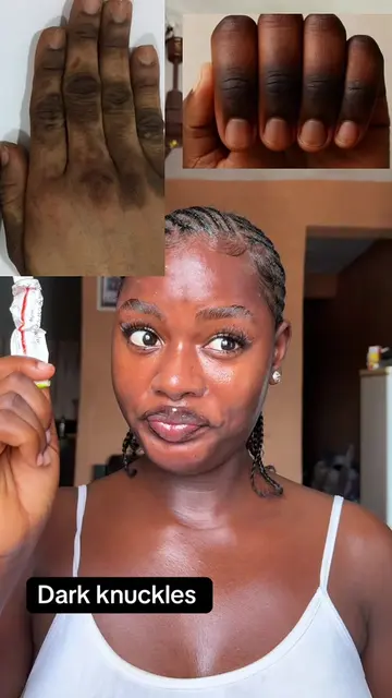 Yes it that good ✨💫 #tretinoin #vaseline #darkknuckles #skincaretips #foryou 