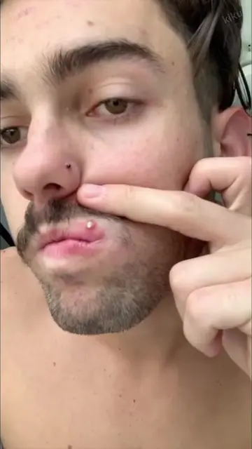 Acne scars and dark spots on my face 🤯 Keep using it and my face will gradually