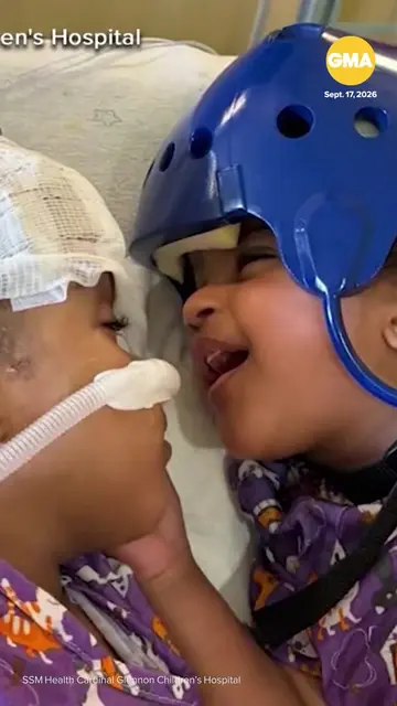 A medical marvel in St. Louis after doctors were able to separate twin sisters b
