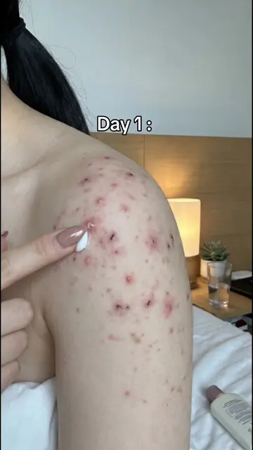 Krim Niasinamid Tea'shell hanya RM11.9 — Hasil kelihatan dalam dua hari sahaja⏳Y