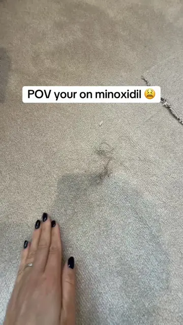 Will it ever end 🤪🤪😂😂😫😫 #minoxidil #minoxidiljourney #dreadshed #dreadshed