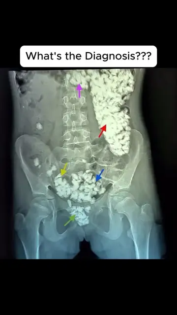 A 14 year old girl with a history of developmental delay is brought into the ER 