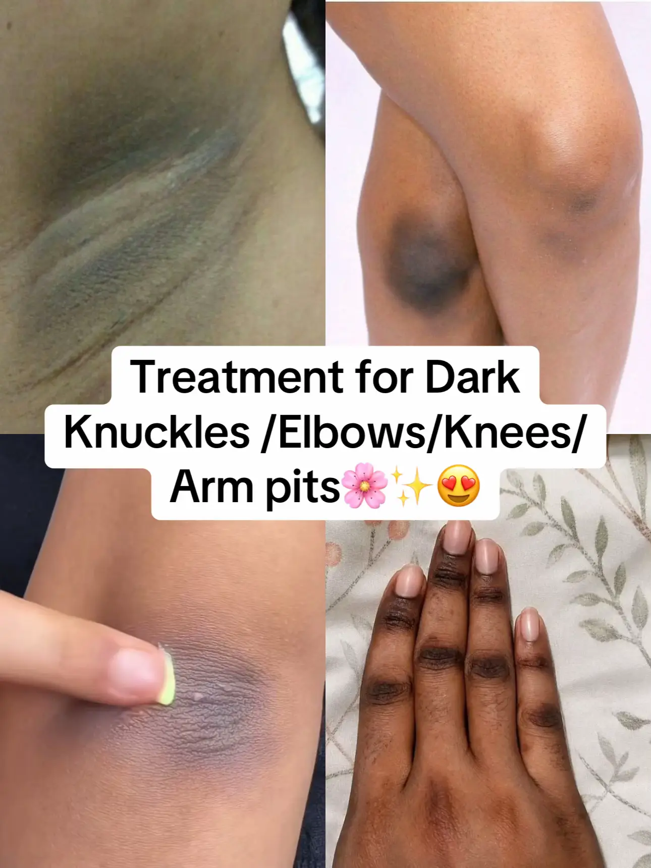 Tired of dark knuckles, knees, dark knees, elbows? The solution is simple: exfol