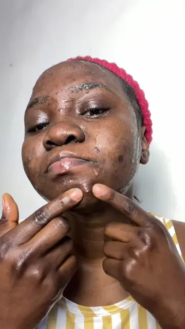 Day 3 / 7 of fighting acne | let’s do my morning skincare routine 😍😍 #timmyall