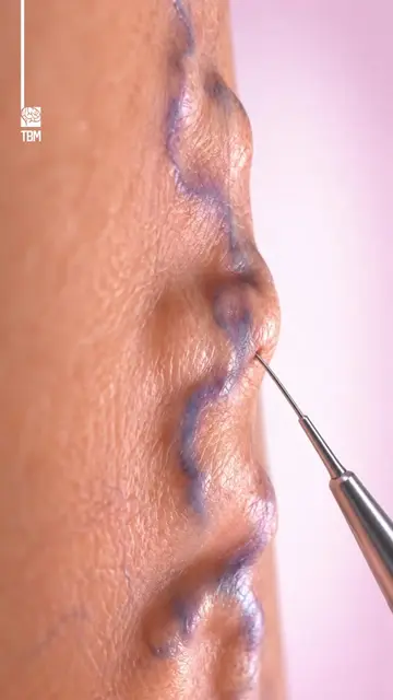 How Varicose Veins Are Treated - How do doctors remove or close bulging varicose