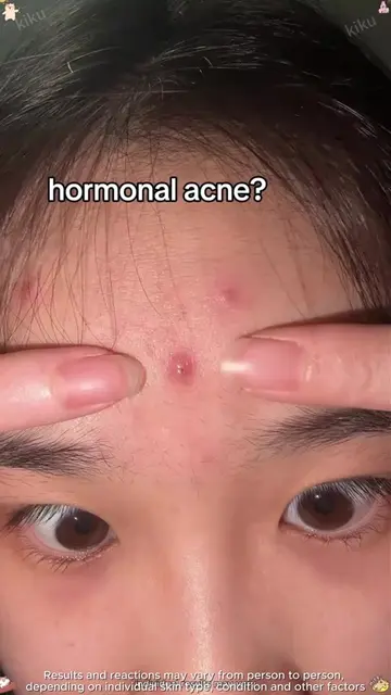 Banish acne marks and dark spots! ✨ Niacinamide cream sweeps away sallowness.YXA