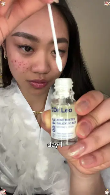 The game-changer that saved my skin!! 💫#salicylicacid #acnetreatment #breakout 