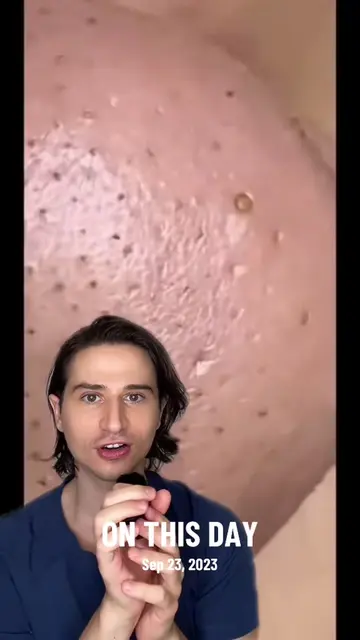 #onthisday SATISFYING EXTRACTIONS #dermreacts  #skincare  #dermatologist #derman