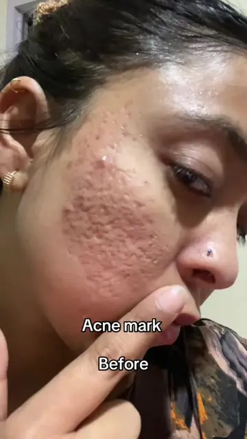 ✨ Stick with using niacinamide cream! My complexion is glowing, and acne marks a