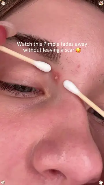 The white stuff that fixes my breakouts #acnetreatment #pimple #drleodryinglotio