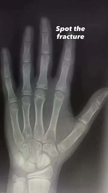 Can you spot the fracture in this hand? 🩻 Take a close look at the X-ray before