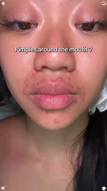 Pimples around the mouth?👄 #tiktokshopstockup #skincare #breakout #acnetreatmen